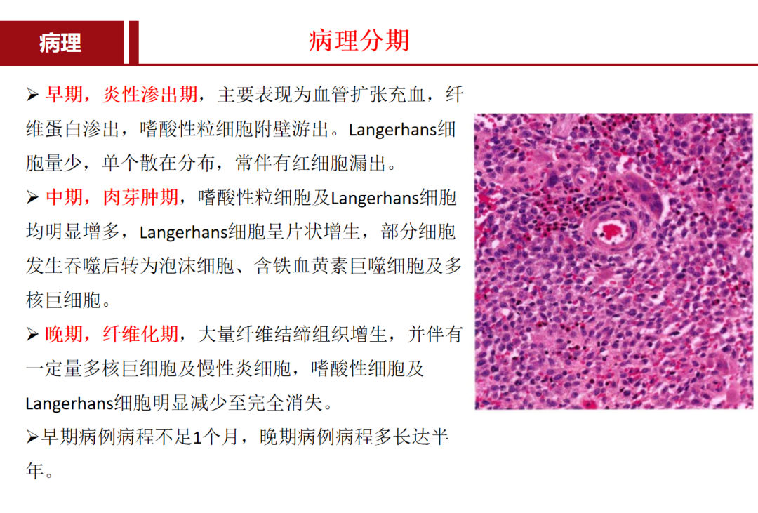朗格汉斯细胞组织细胞增多症，一种儿童罕见骨病，本文给你讲清楚了！