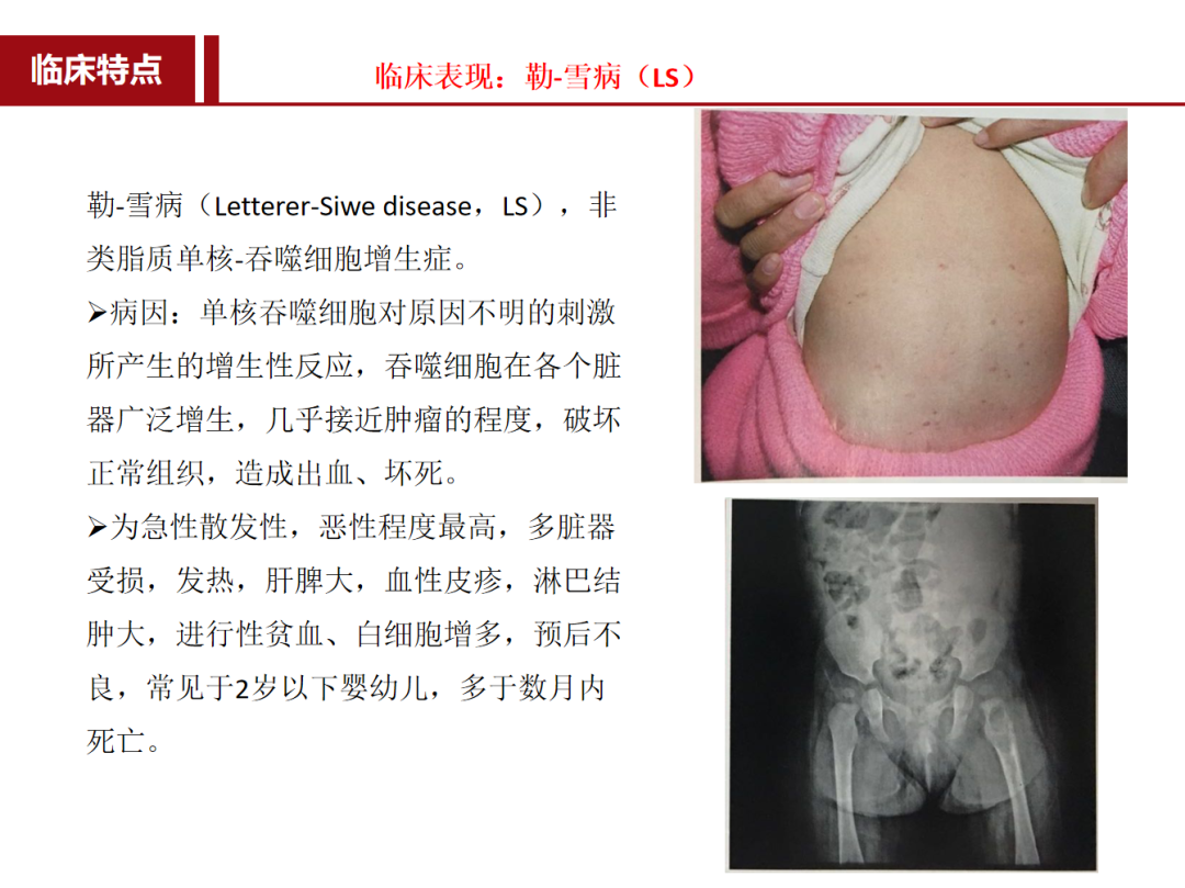 朗格汉斯细胞组织细胞增多症，一种儿童罕见骨病，本文给你讲清楚了！