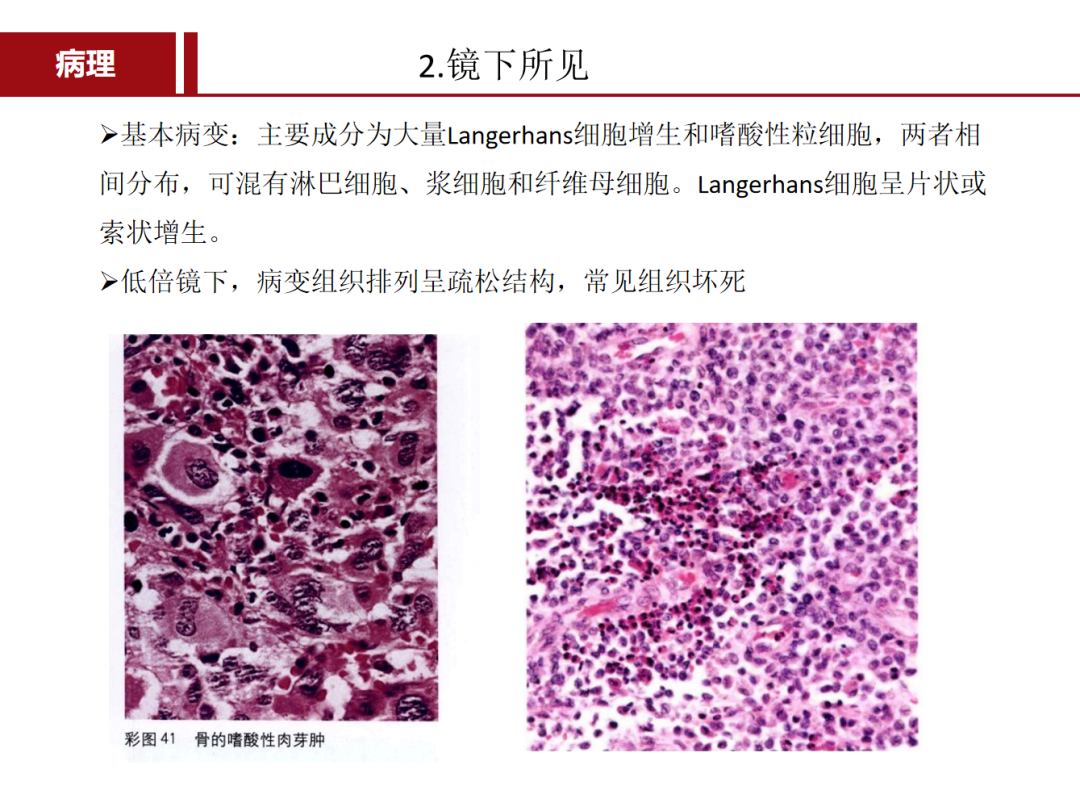 朗格汉斯细胞组织细胞增多症，一种儿童罕见骨病，本文给你讲清楚了！