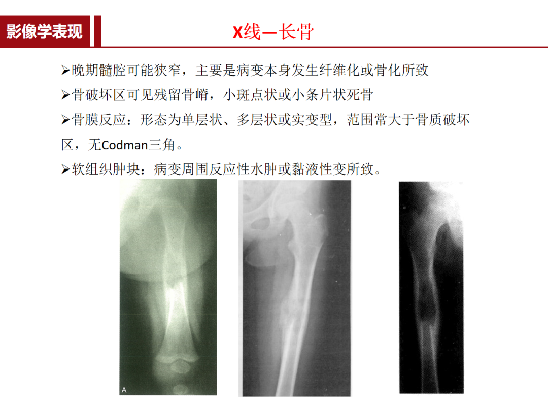 朗格汉斯细胞组织细胞增多症，一种儿童罕见骨病，本文给你讲清楚了！