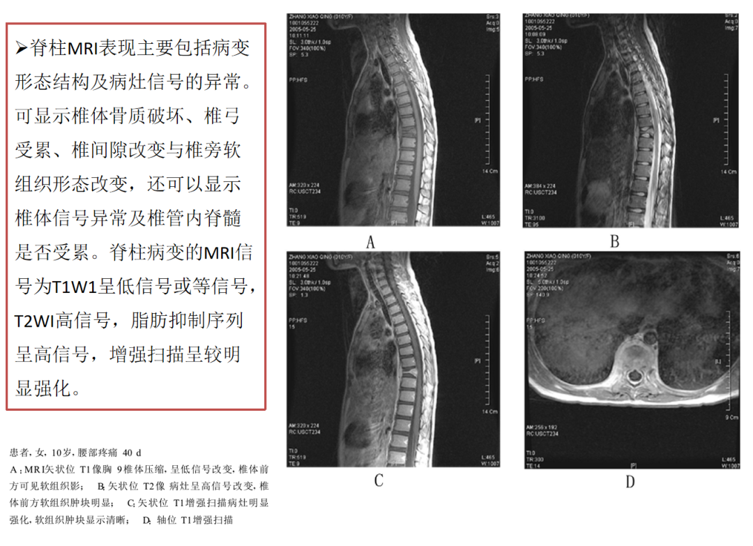 朗格汉斯细胞组织细胞增多症，一种儿童罕见骨病，本文给你讲清楚了！