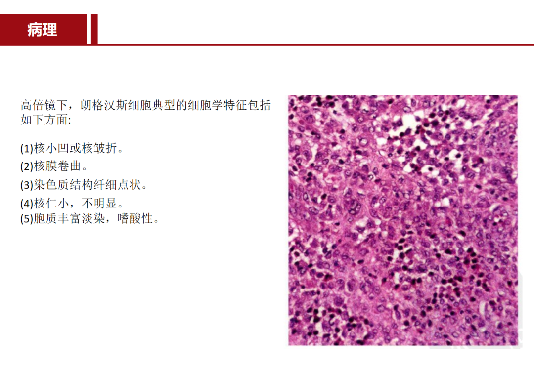 朗格汉斯细胞组织细胞增多症，一种儿童罕见骨病，本文给你讲清楚了！