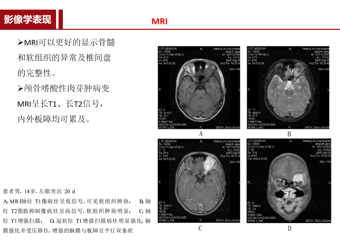 朗格汉斯细胞组织细胞增多症，一种儿童罕见骨病，本文给你讲清楚了！