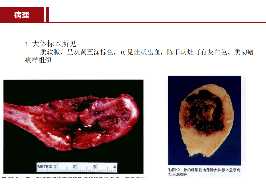 朗格汉斯细胞组织细胞增多症，一种儿童罕见骨病，本文给你讲清楚了！