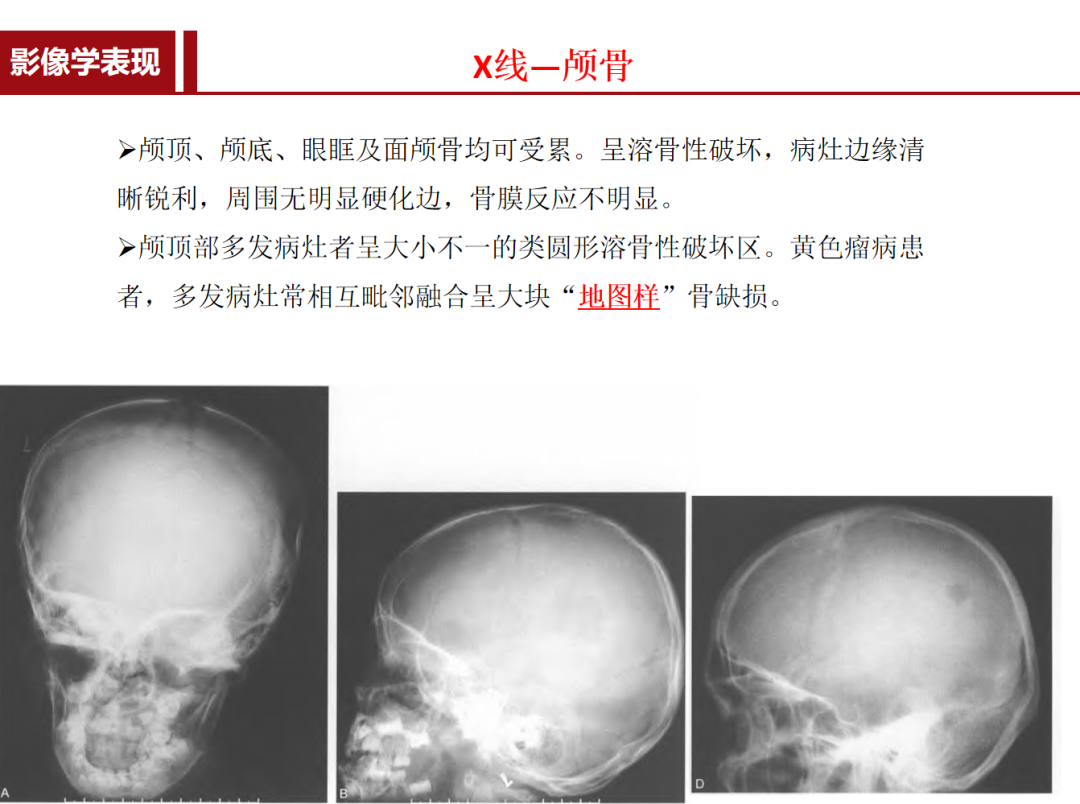 朗格汉斯细胞组织细胞增多症，一种儿童罕见骨病，本文给你讲清楚了！