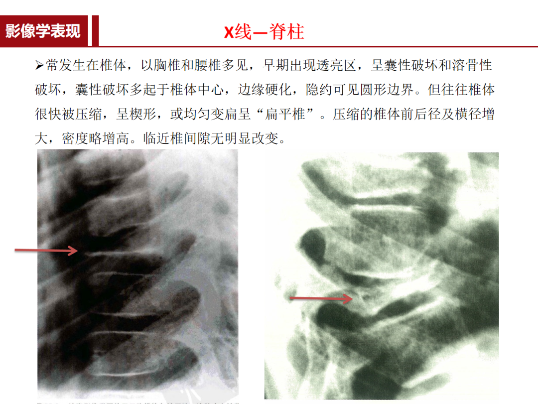 朗格汉斯细胞组织细胞增多症，一种儿童罕见骨病，本文给你讲清楚了！