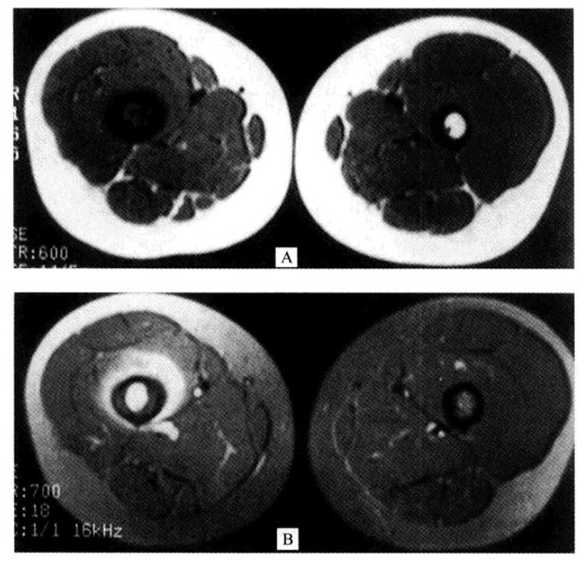 朗格汉斯细胞组织细胞增多症，一种儿童罕见骨病，本文给你讲清楚了！