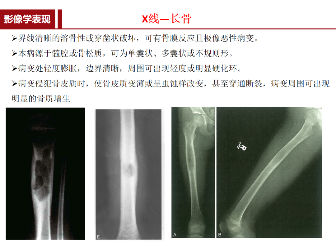 朗格汉斯细胞组织细胞增多症，一种儿童罕见骨病，本文给你讲清楚了！