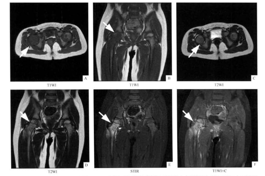 朗格汉斯细胞组织细胞增多症，一种儿童罕见骨病，本文给你讲清楚了！