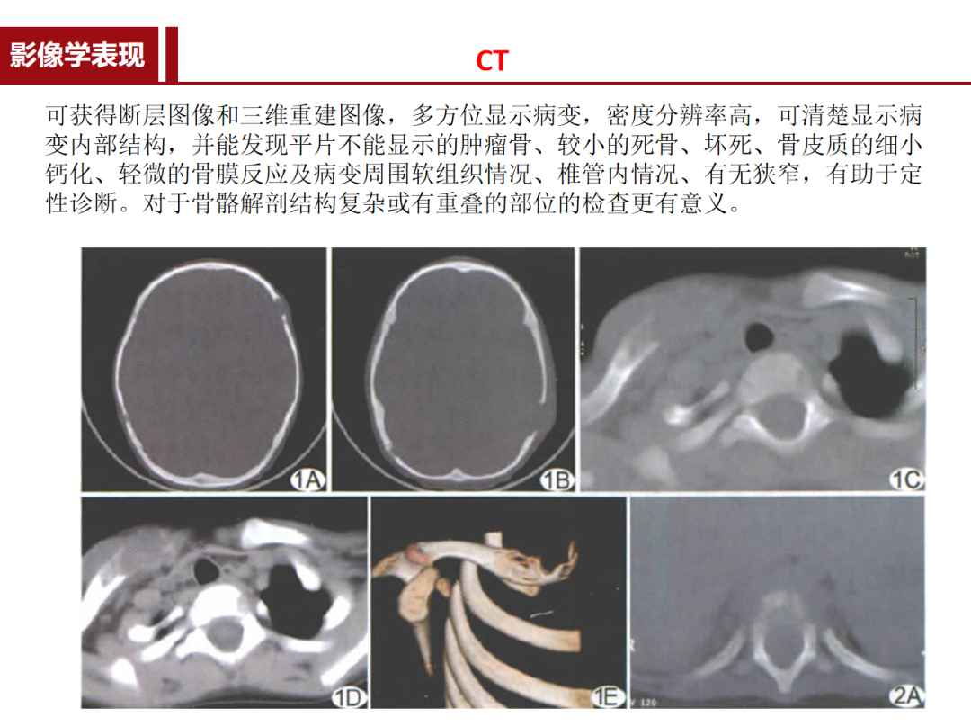 朗格汉斯细胞组织细胞增多症，一种儿童罕见骨病，本文给你讲清楚了！