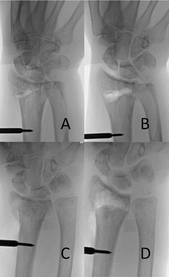怎么使用牵引器早读 ｜ 使用“迷你牵引器”治疗桡骨远端骨折的新型手术技术_https://www.jmylbn.com_新闻资讯_第5张