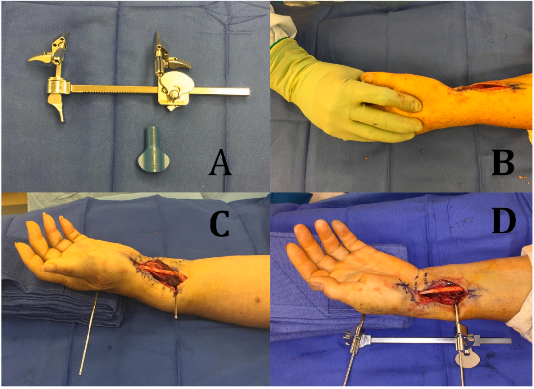 怎么使用牵引器早读 ｜ 使用“迷你牵引器”治疗桡骨远端骨折的新型手术技术_https://www.jmylbn.com_新闻资讯_第4张