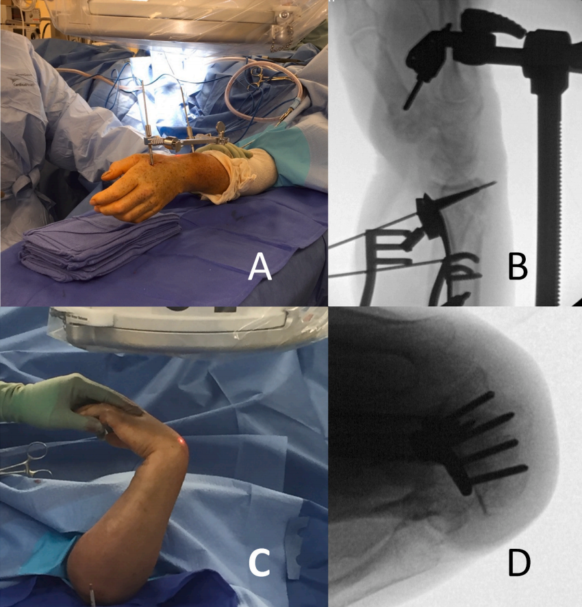 怎么使用牵引器早读 ｜ 使用“迷你牵引器”治疗桡骨远端骨折的新型手术技术_https://www.jmylbn.com_新闻资讯_第8张