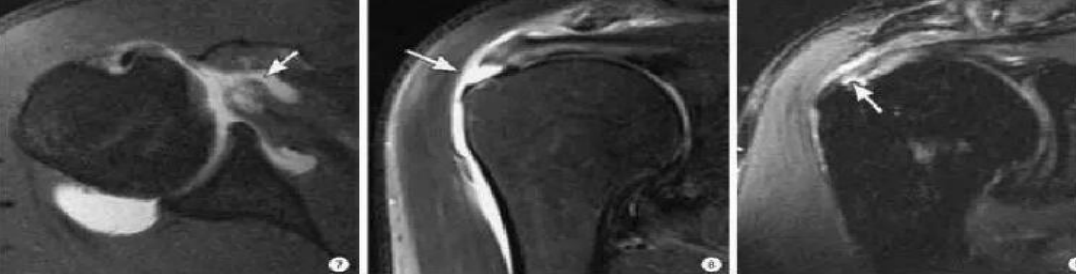 肩袖损伤的诊断与治疗，史上最全总结！