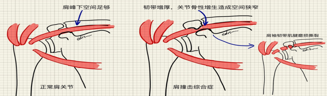 肩袖损伤的诊断与治疗，史上最全总结！