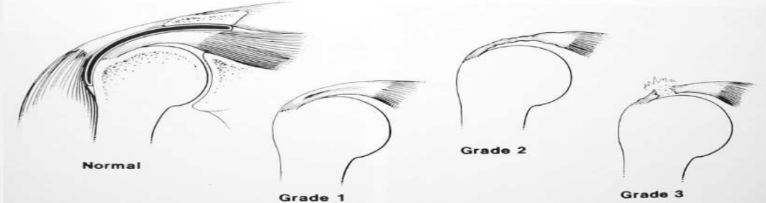 肩袖损伤的诊断与治疗，史上最全总结！