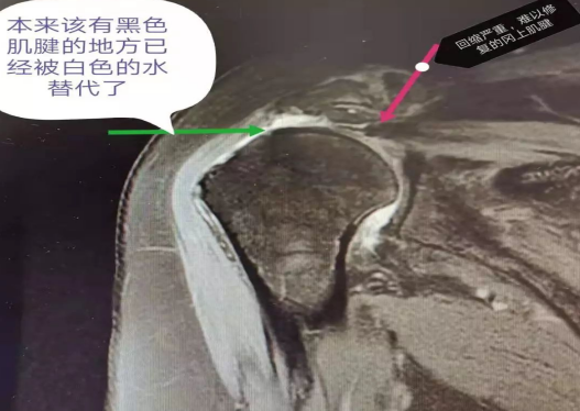 肩袖损伤的诊断与治疗，史上最全总结！