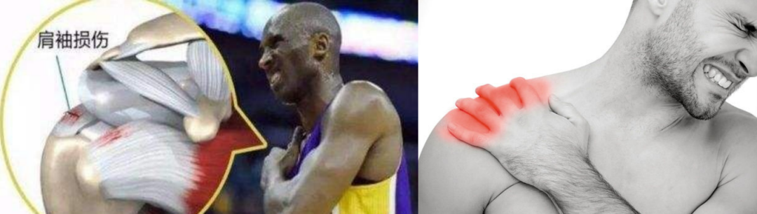 肩袖损伤的诊断与治疗，史上最全总结！