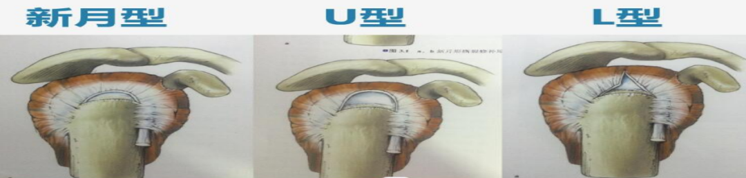 肩袖损伤的诊断与治疗，史上最全总结！