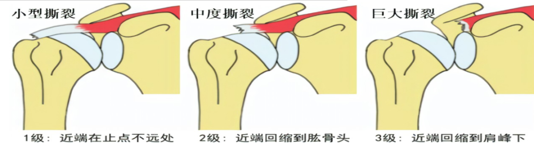 肩袖损伤的诊断与治疗，史上最全总结！