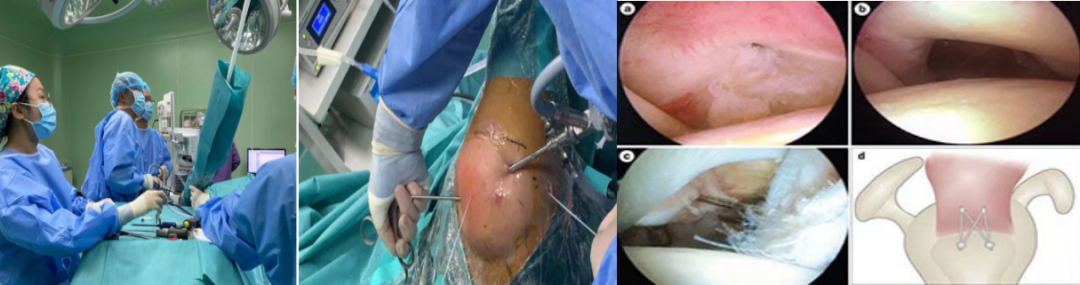 肩袖损伤的诊断与治疗，史上最全总结！