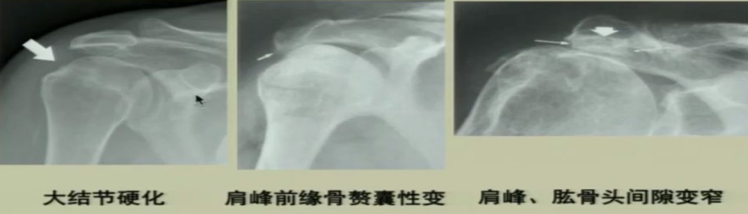 肩袖损伤的诊断与治疗，史上最全总结！