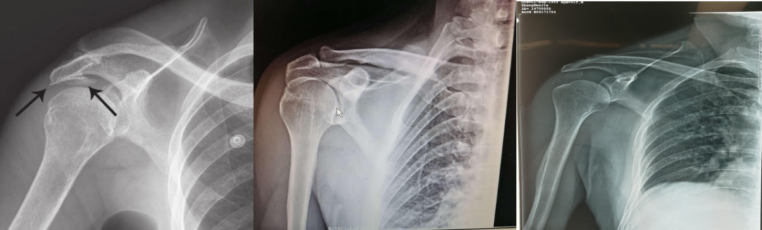 肩袖损伤的诊断与治疗，史上最全总结！