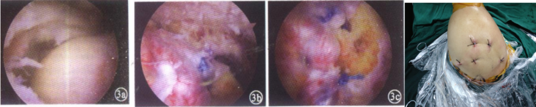 肩袖损伤的诊断与治疗，史上最全总结！