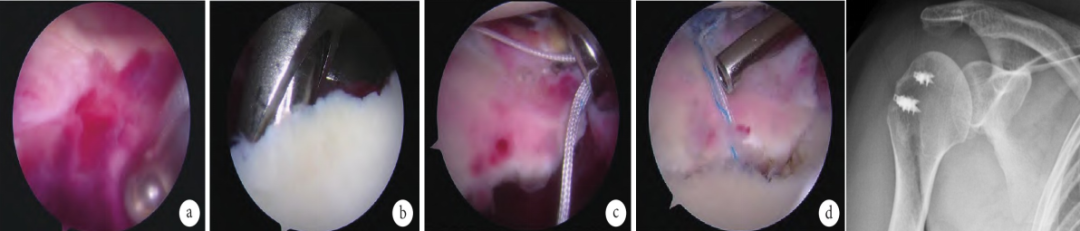 肩袖损伤的诊断与治疗，史上最全总结！