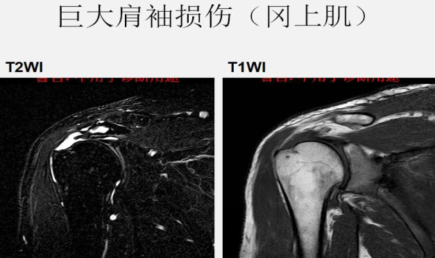 肩袖损伤的诊断与治疗，史上最全总结！