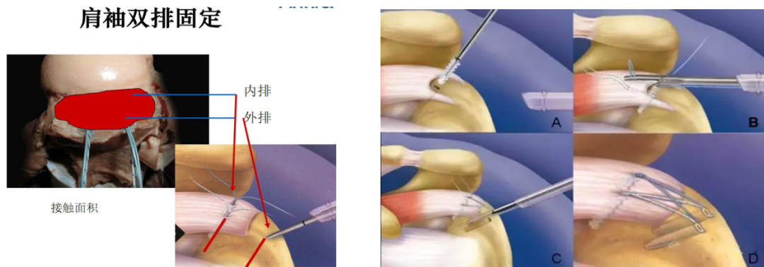 肩袖损伤的诊断与治疗，史上最全总结！
