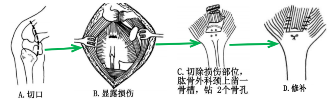 肩袖损伤的诊断与治疗，史上最全总结！