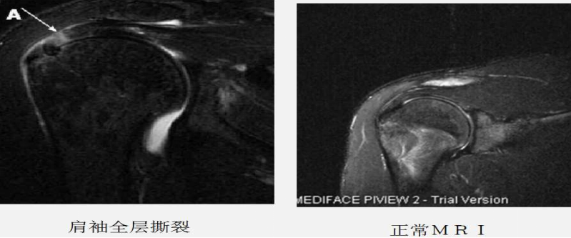 肩袖损伤的诊断与治疗，史上最全总结！