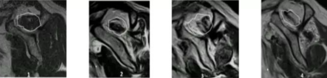 肩袖损伤的诊断与治疗，史上最全总结！