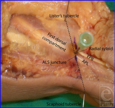 什么叫桡鞘早读 ｜ 切除第一背侧间室腱鞘治疗桡骨茎突狭窄性腱鞘炎新技术_https://www.jmylbn.com_新闻资讯_第3张