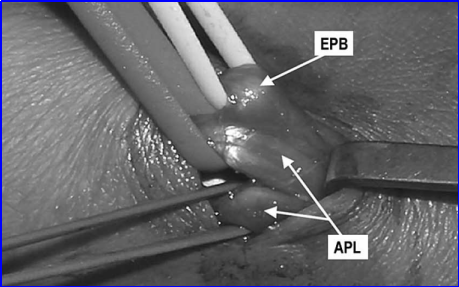 什么叫桡鞘早读 ｜ 切除第一背侧间室腱鞘治疗桡骨茎突狭窄性腱鞘炎新技术_https://www.jmylbn.com_新闻资讯_第6张