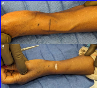 什么叫桡鞘早读 ｜ 切除第一背侧间室腱鞘治疗桡骨茎突狭窄性腱鞘炎新技术_https://www.jmylbn.com_新闻资讯_第7张