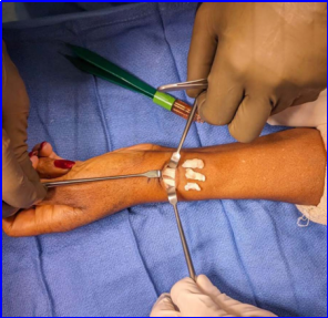 什么叫桡鞘早读 ｜ 切除第一背侧间室腱鞘治疗桡骨茎突狭窄性腱鞘炎新技术_https://www.jmylbn.com_新闻资讯_第8张