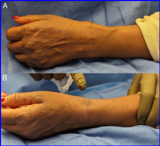 什么叫桡鞘早读 ｜ 切除第一背侧间室腱鞘治疗桡骨茎突狭窄性腱鞘炎新技术_https://www.jmylbn.com_新闻资讯_第9张