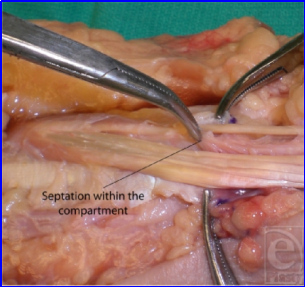 什么叫桡鞘早读 ｜ 切除第一背侧间室腱鞘治疗桡骨茎突狭窄性腱鞘炎新技术_https://www.jmylbn.com_新闻资讯_第4张