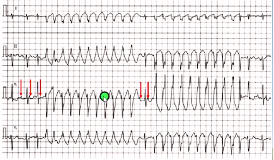 心律解码丨房颤合并差传和预激综合征心电图鉴别