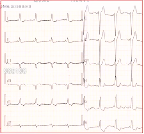 心律解码丨房颤合并差传和预激综合征心电图鉴别