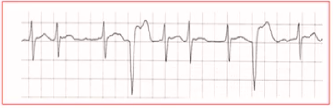 心律解码丨房颤合并差传和预激综合征心电图鉴别