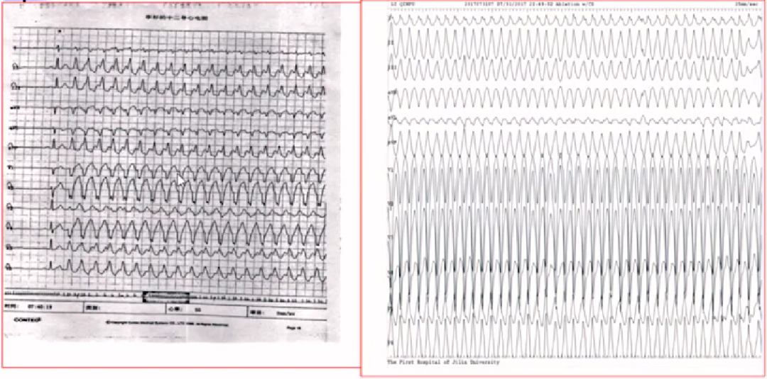 心律解码丨房颤合并差传和预激综合征心电图鉴别