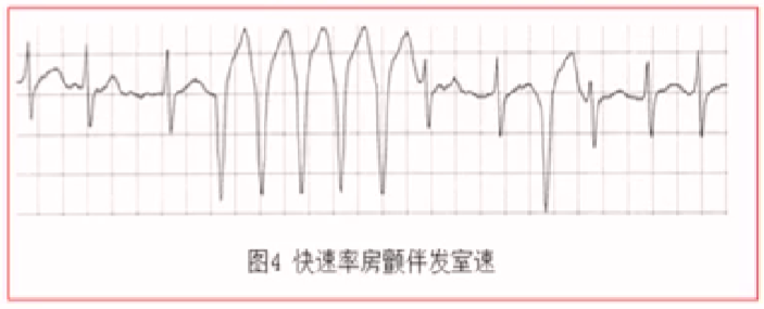 心律解码丨房颤合并差传和预激综合征心电图鉴别