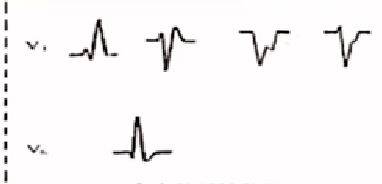 心律解码丨房颤合并差传和预激综合征心电图鉴别