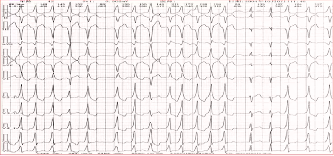 心律解码丨房颤合并差传和预激综合征心电图鉴别