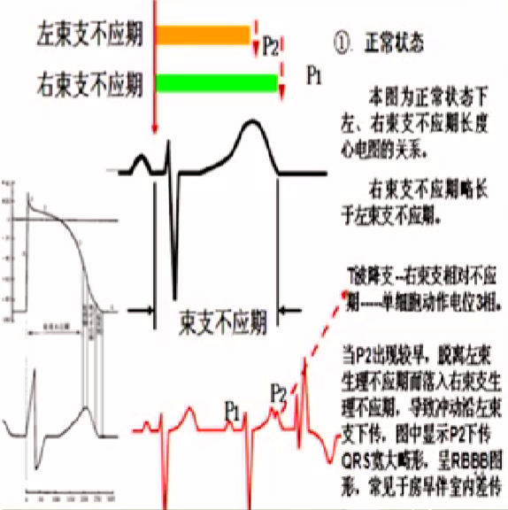 心律解码丨房颤合并差传和预激综合征心电图鉴别