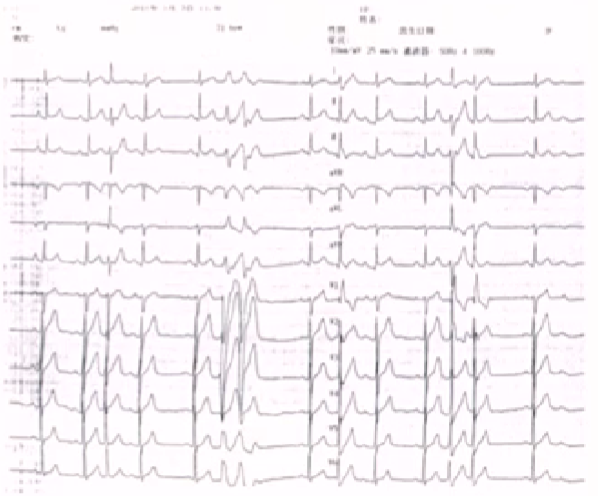 心律解码丨房颤合并差传和预激综合征心电图鉴别