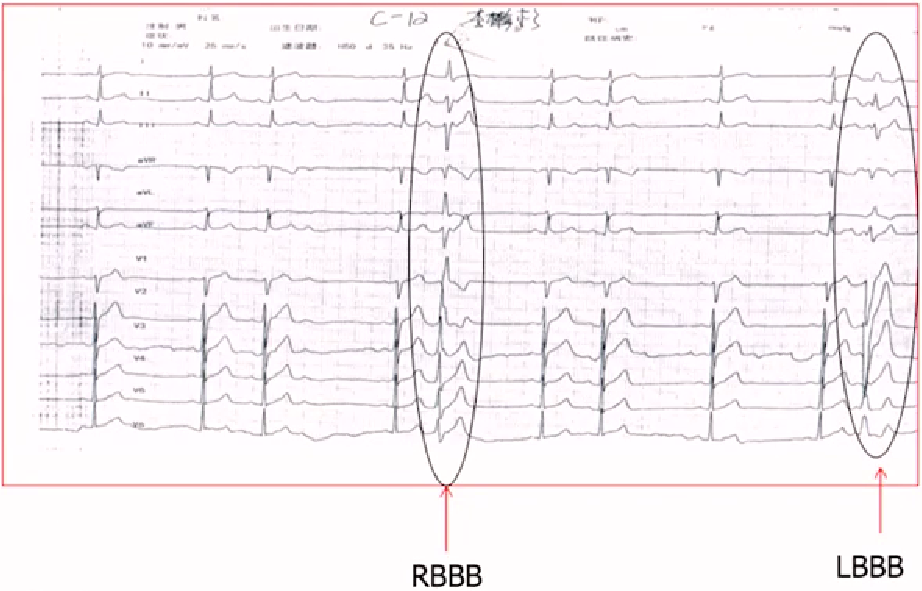 心律解码丨房颤合并差传和预激综合征心电图鉴别
